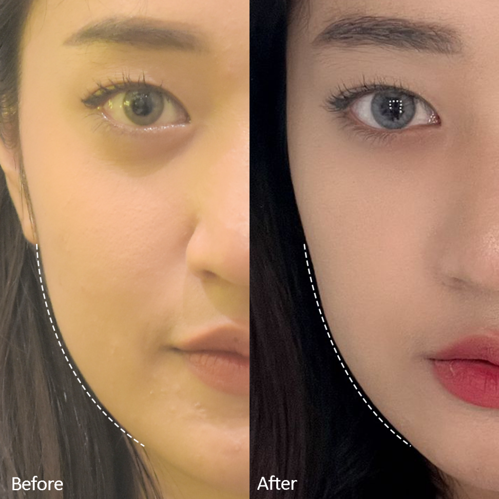 Insta Beauty Aesthetic Clinic - Face Contouring & Beautification
